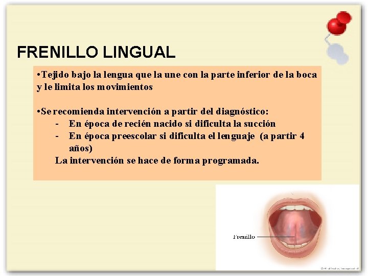 FRENILLO LINGUAL • Tejido bajo la lengua que la une con la parte inferior