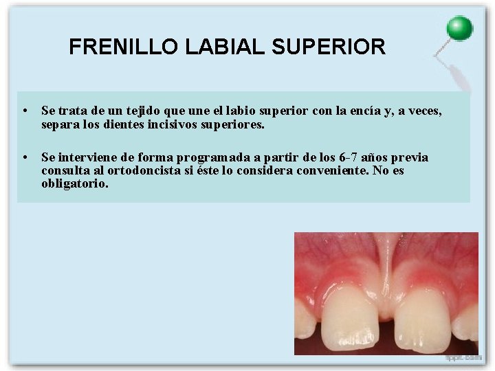 FRENILLO LABIAL SUPERIOR • Se trata de un tejido que une el labio superior