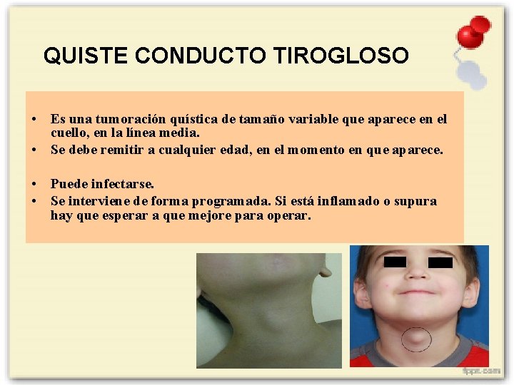 QUISTE CONDUCTO TIROGLOSO • Es una tumoración quística de tamaño variable que aparece en