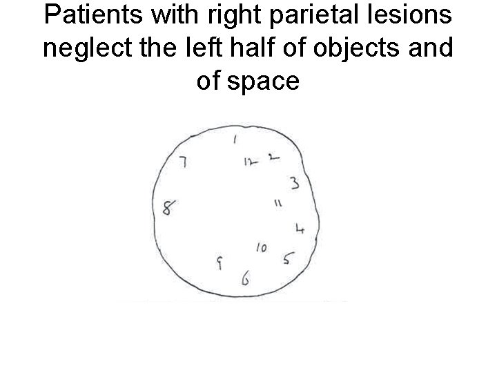 Patients with right parietal lesions neglect the left half of objects and of space Patients with right parietal lesions neglect the left half of objects and of space