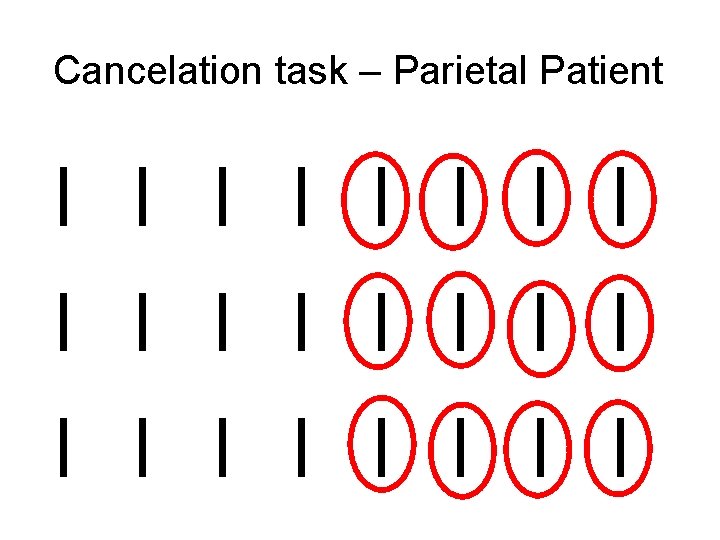 Cancelation task – Parietal Patient 