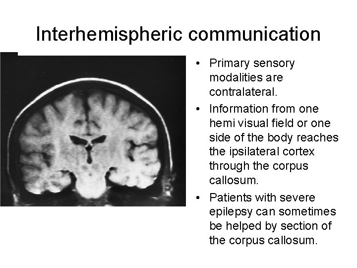 Interhemispheric communication • Primary sensory modalities are contralateral. • Information from one hemi visual