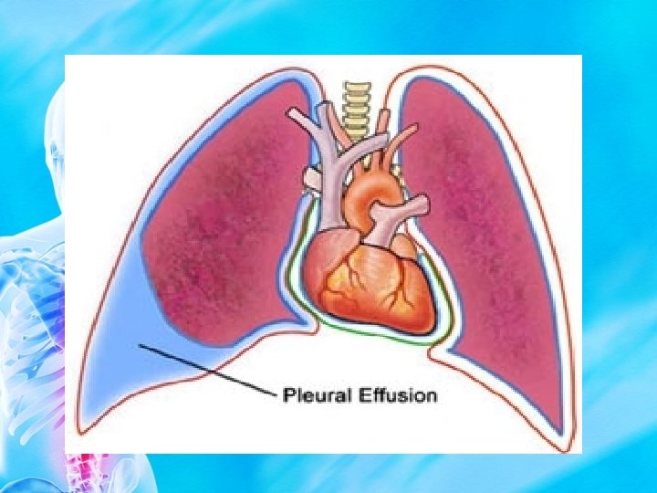 Diseases of the Pleura DR Alaa Rashad Diseases