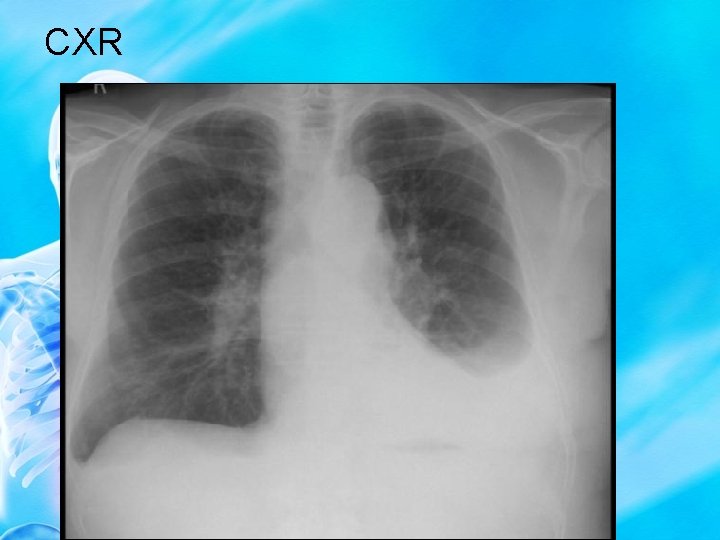 CXR 