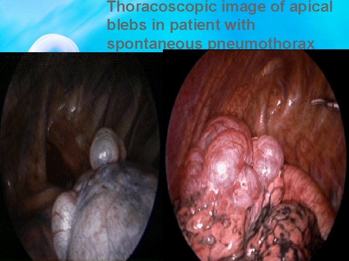 Thoracoscopic image of apical blebs in patient with spontaneous pneumothorax 