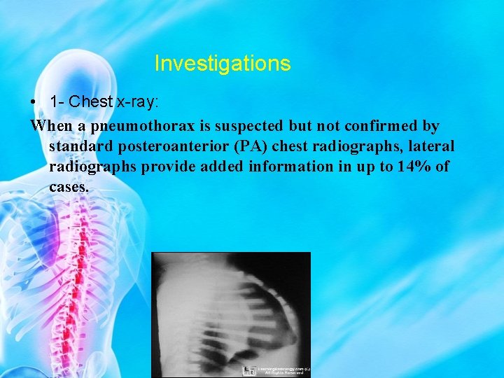 Investigations • 1 - Chest x-ray: When a pneumothorax is suspected but not confirmed