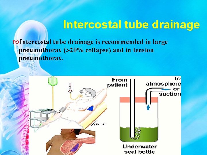 Intercostal tube drainage is recommended in large pneumothorax ( 20% collapse) and in tension