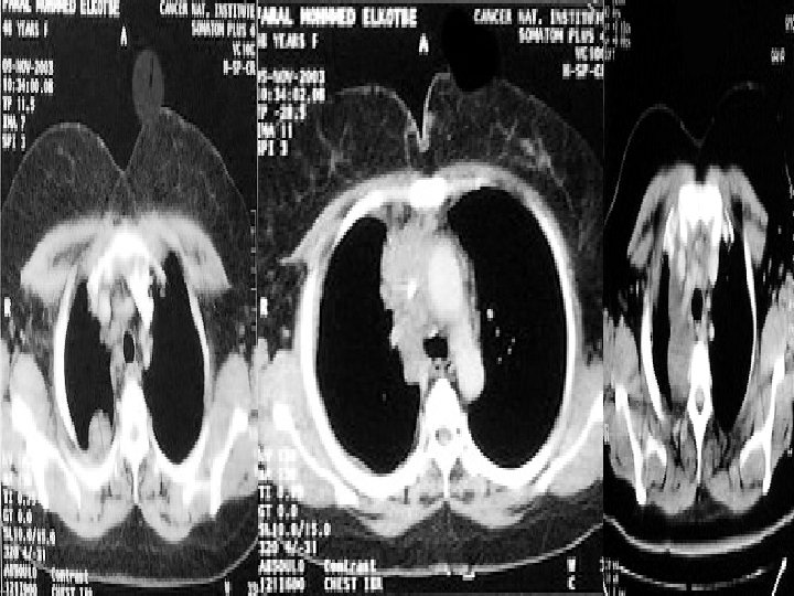 Diseases of the Pleura DR Alaa Rashad Diseases