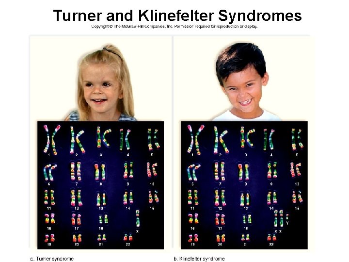 Turner and Klinefelter Syndromes 