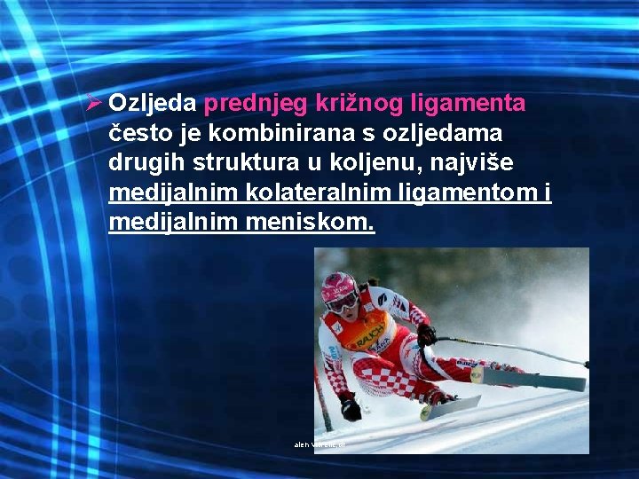 Ø Ozljeda prednjeg križnog ligamenta često je kombinirana s ozljedama drugih struktura u koljenu,