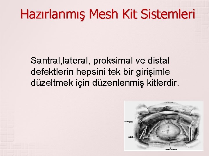 Hazırlanmış Mesh Kit Sistemleri Santral, lateral, proksimal ve distal defektlerin hepsini tek bir girişimle