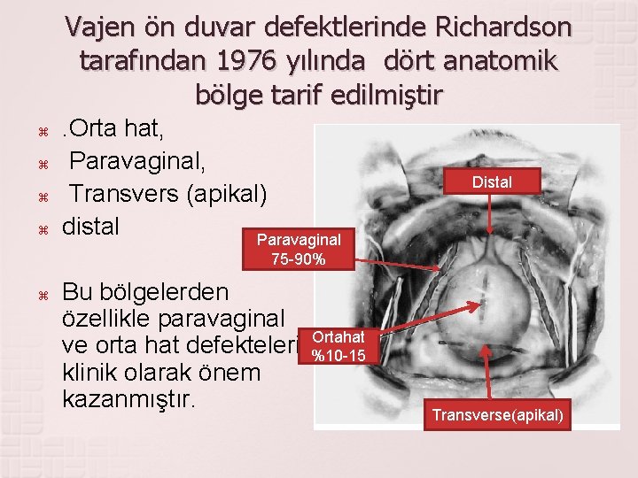 Vajen ön duvar defektlerinde Richardson tarafından 1976 yılında dört anatomik bölge tarif edilmiştir .