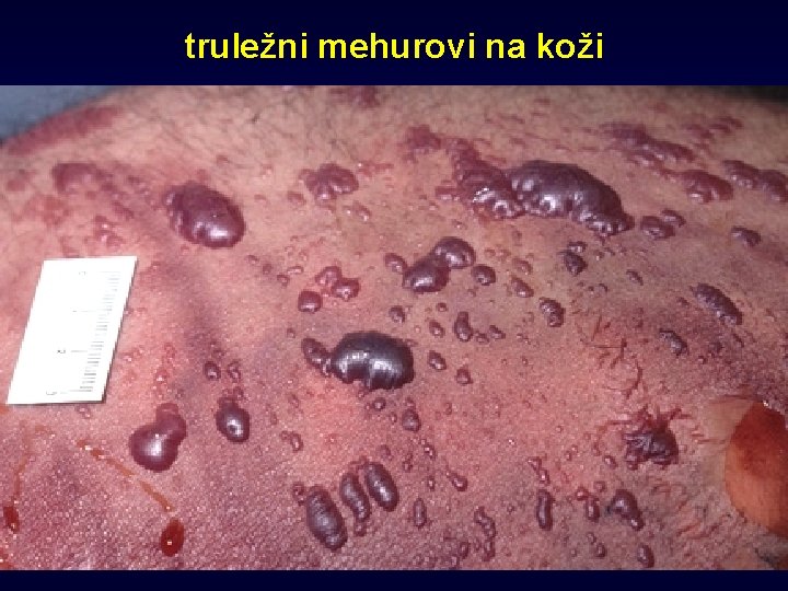 truležni mehurovi na koži 