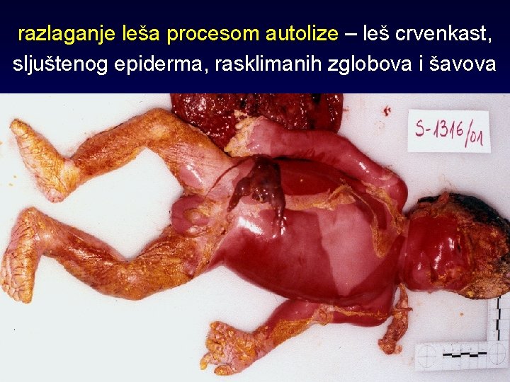 razlaganje leša procesom autolize – leš crvenkast, sljuštenog epiderma, rasklimanih zglobova i šavova 