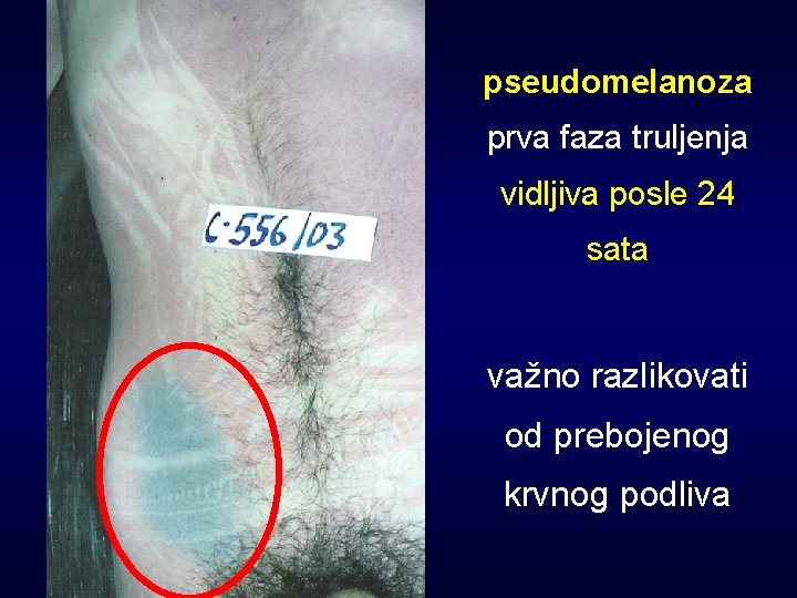pseudomelanoza prva faza truljenja vidljiva posle 24 sata važno razlikovati od prebojenog krvnog podliva