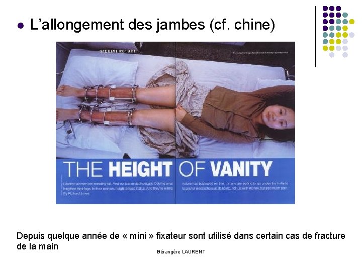 l L’allongement des jambes (cf. chine) Depuis quelque année de « mini » fixateur