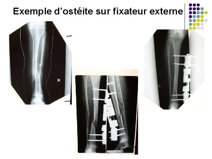Exemple d’ostéite sur fixateur externe Bérangère LAURENT 