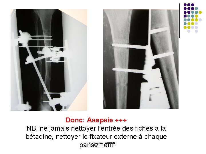 Donc: Asepsie +++ NB: ne jamais nettoyer l’entrée des fiches à la bétadine, nettoyer