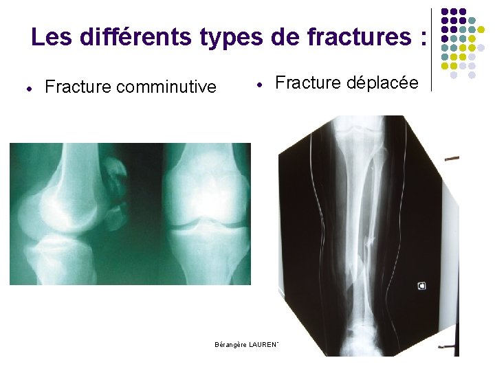 Les différents types de fractures : Fracture comminutive Fracture déplacée Bérangère LAURENT 
