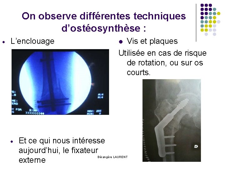 On observe différentes techniques d’ostéosynthèse : Vis et plaques Utilisée en cas de risque