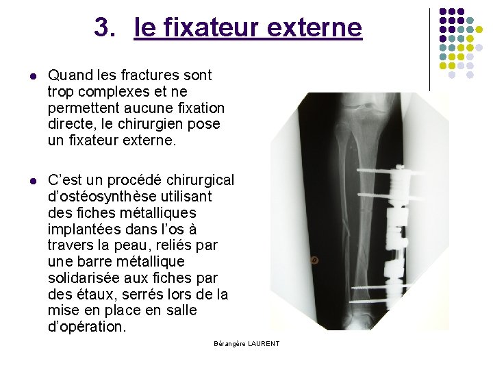 3. le fixateur externe l Quand les fractures sont trop complexes et ne permettent