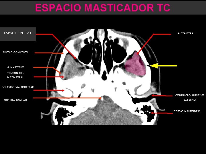 ESPACIO MASTICADOR TC ESPACIO BUCAL M. TEMPORAL ARCO CIGOMATICO M. MASETERO TENDON DEL M.