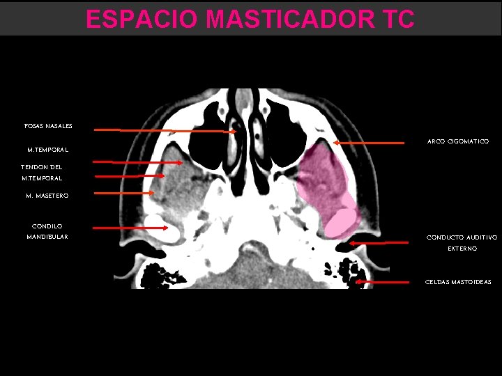 ESPACIO MASTICADOR TC FOSAS NASALES M. TEMPORAL ARCO CIGOMATICO TENDON DEL M. TEMPORAL M.