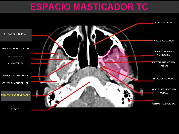 ESPACIO MASTICADOR TC FOSAS NASALES ESPACIO BUCAL ARCO CIGOMATICO TENDON DEL M. TEMPORAL M.