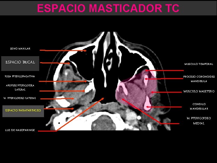 ESPACIO MASTICADOR TC SENO MAXILAR ESPACIO BUCAL FOSA PTERIGOPALATINA APOFISIS PTERIGOIDEA LATERAL MUSCULO TEMPORAL