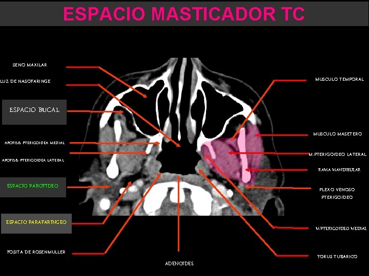 ESPACIO MASTICADOR TC SENO MAXILAR MUSCULO TEMPORAL LUZ DE NASOFARINGE ESPACIO BUCAL MUSCULO MASETERO