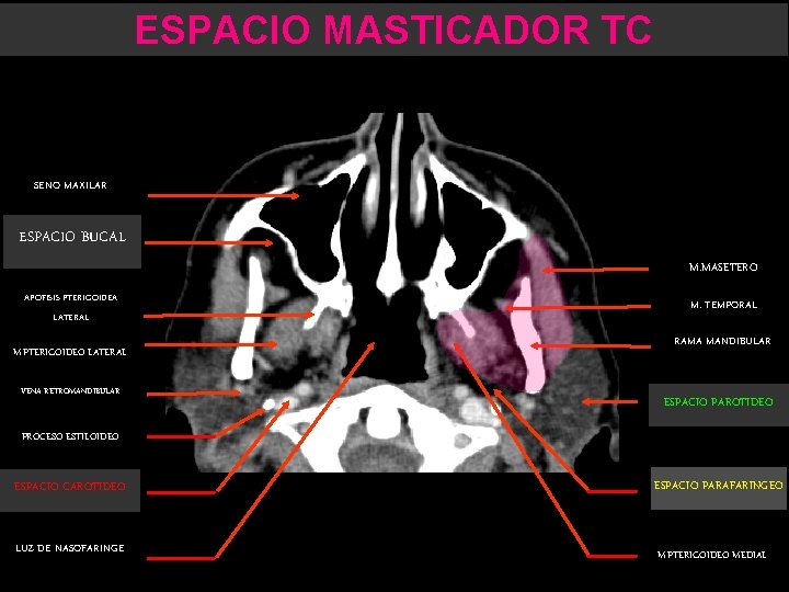 ESPACIO MASTICADOR TC SENO MAXILAR ESPACIO BUCAL M. MASETERO APOFISIS PTERIGOIDEA LATERAL M. PTERIGOIDEO