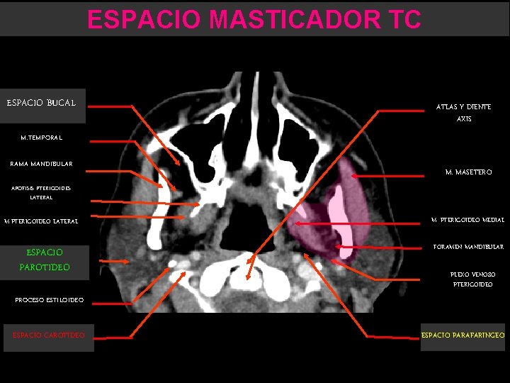 ESPACIO MASTICADOR TC ESPACIO BUCAL ATLAS Y DIENTE AXIS M. TEMPORAL RAMA MANDIBULAR M.