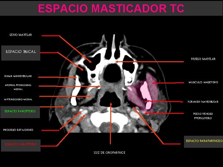 ESPACIO MASTICADOR TC SENO MAXILAR ESPACIO BUCAL HUESO MAXILAR RAMA MANDIBULAR MUSCULO MASETERO APOFISIS