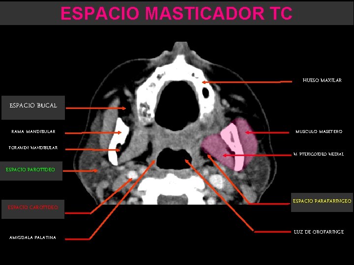 ESPACIO MASTICADOR TC HUESO MAXILAR ESPACIO BUCAL RAMA MANDIBULAR FORAMEN MANDIBULAR MUSCULO MASETERO M.