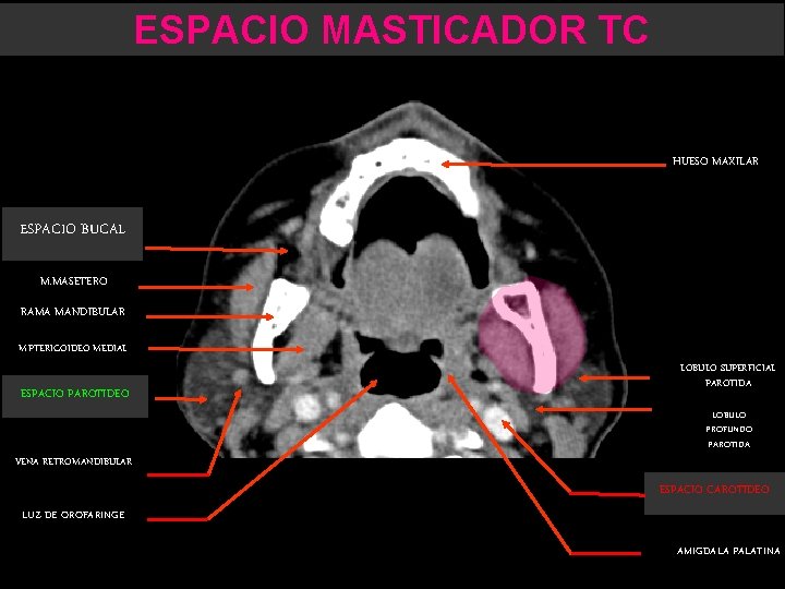 ESPACIO MASTICADOR TC HUESO MAXILAR ESPACIO BUCAL M. MASETERO RAMA MANDIBULAR M. PTERIGOIDEO MEDIAL