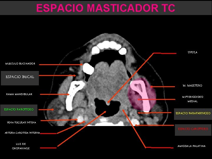ESPACIO MASTICADOR TC UVULA MUSCULO BUCINADOR ESPACIO BUCAL M. MASETERO RAMA MANDIBULAR ESPACIO PAROTIDEO