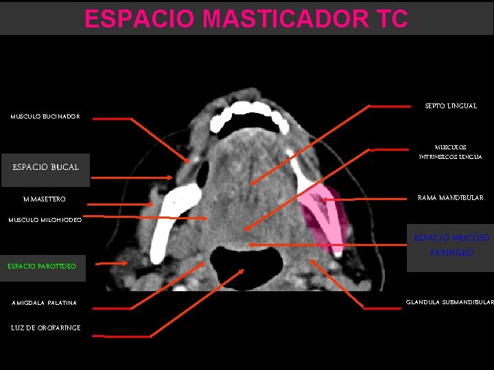 ESPACIO MASTICADOR TC MUSCULO BUCINADOR ESPACIO BUCAL M. MASETERO SEPTO LINGUAL MUSCULOS INTRINSECOS LENGUA