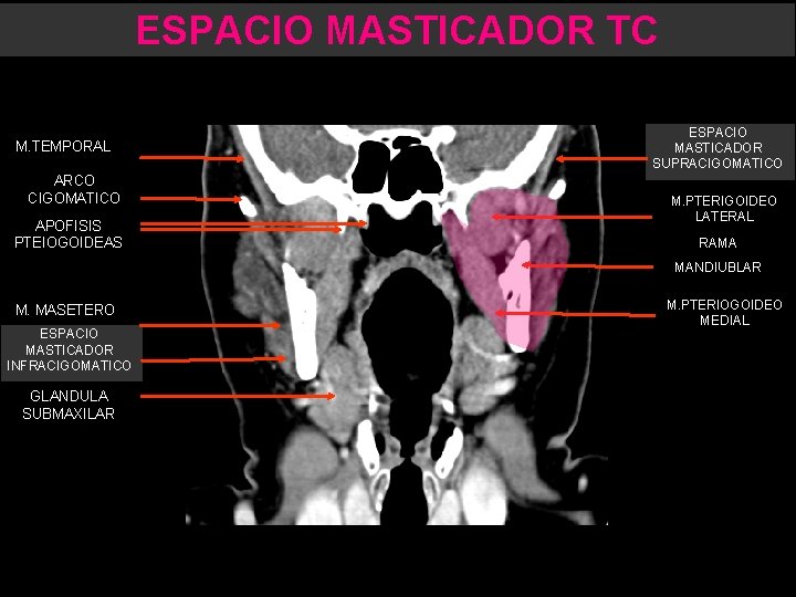 ESPACIO MASTICADOR TC M. TEMPORAL ARCO CIGOMATICO APOFISIS PTEIOGOIDEAS ESPACIO MASTICADOR SUPRACIGOMATICO M. PTERIGOIDEO