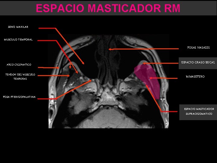 ESPACIO MASTICADOR RM SENO MAXILAR MUSCULO TEMPORAL FOSAS NASALES ARCO CIGOMATICO TENDON DEL MUSCULO