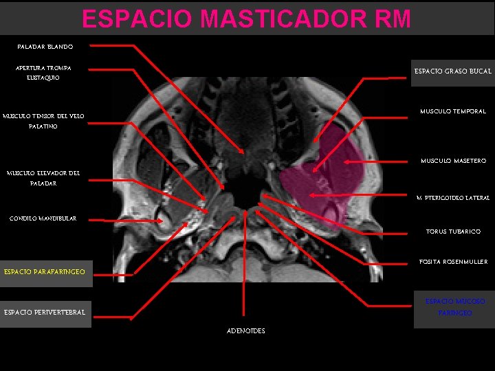 ESPACIO MASTICADOR RM PALADAR BLANDO APERTURA TROMPA EUSTAQUIO ESPACIO GRASO BUCAL MUSCULO TEMPORAL MUSCULO