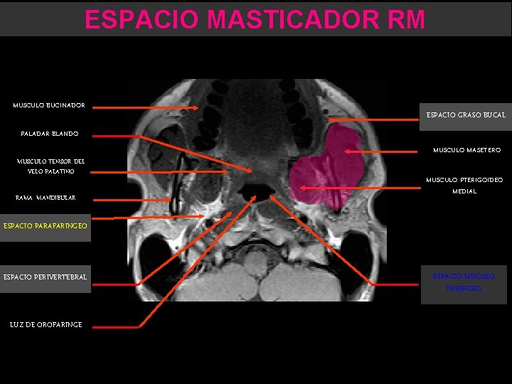 ESPACIO MASTICADOR RM MUSCULO BUCINADOR ESPACIO GRASO BUCAL PALADAR BLANDO MUSCULO TENSOR DEL VELO