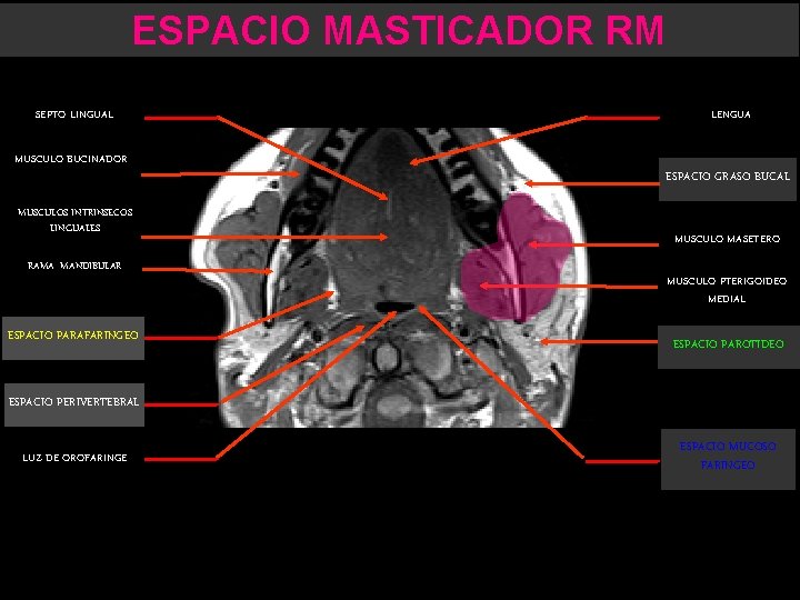 ESPACIO MASTICADOR RM SEPTO LINGUAL MUSCULO BUCINADOR MUSCULOS INTRINSECOS LINGUALES RAMA MANDIBULAR ESPACIO PARAFARINGEO