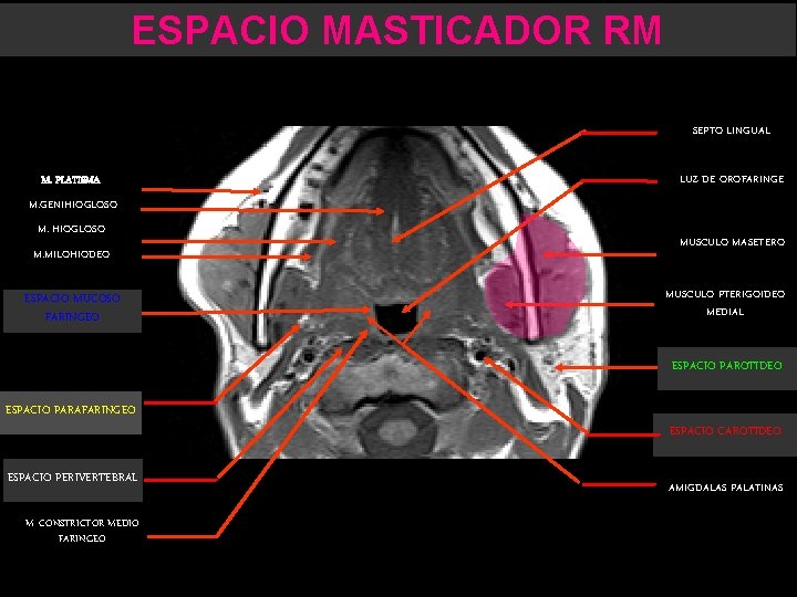 ESPACIO MASTICADOR RM SEPTO LINGUAL M. PLATISMA LUZ DE OROFARINGE M. GENIHIOGLOSO M. MILOHIODEO