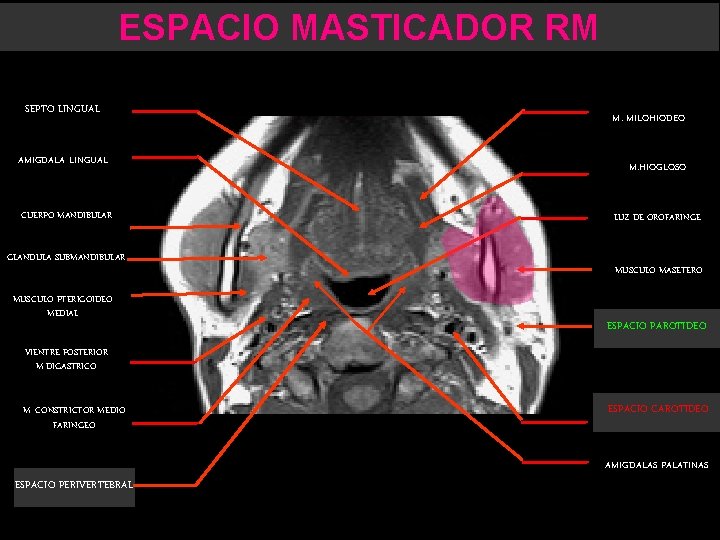 ESPACIO MASTICADOR RM SEPTO LINGUAL AMIGDALA LINGUAL CUERPO MANDIBULAR GLANDULA SUBMANDIBULAR MUSCULO PTERIGOIDEO MEDIAL