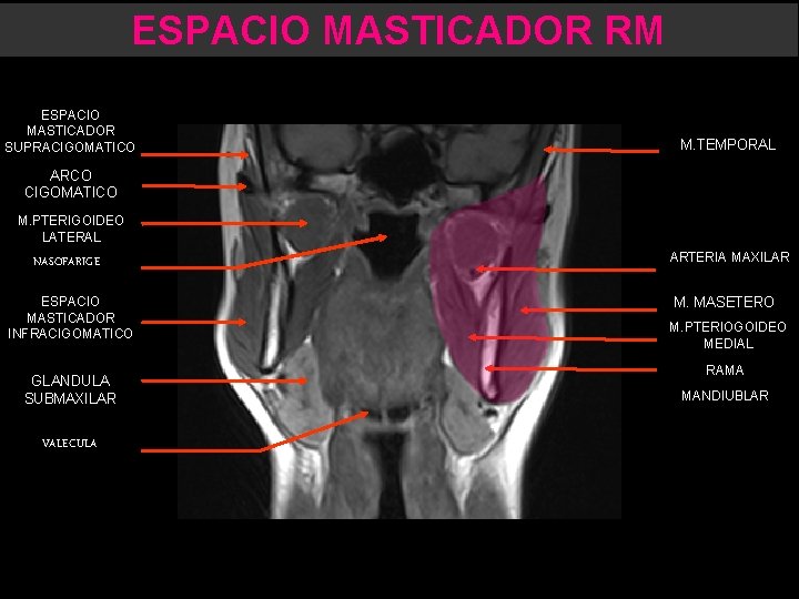 ESPACIO MASTICADOR RM ESPACIO MASTICADOR SUPRACIGOMATICO M. TEMPORAL ARCO CIGOMATICO M. PTERIGOIDEO LATERAL NASOFARIGE