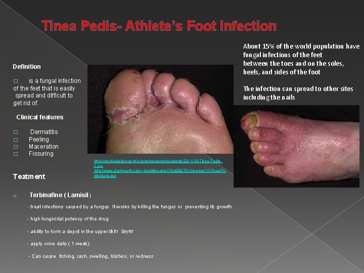 Tinea Pedis- Athlete’s Foot Infection Definition About 15% of the world population have fungal