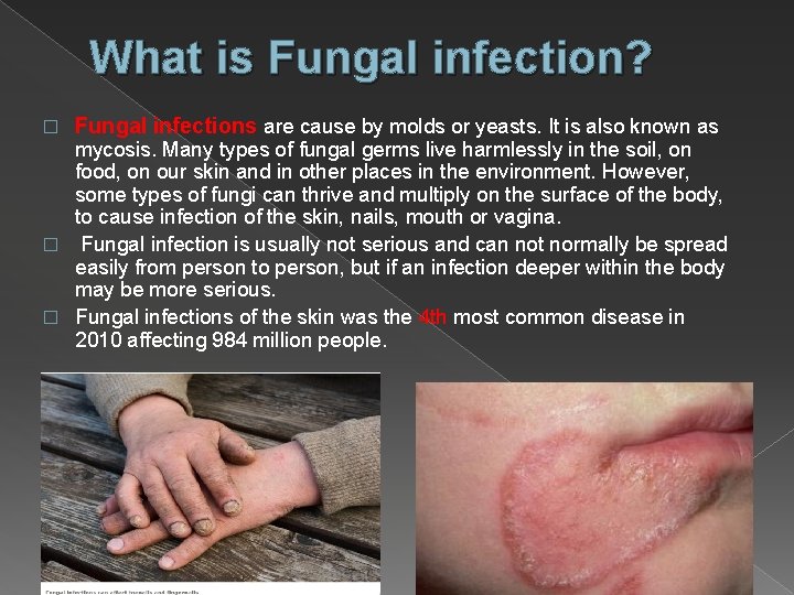 What is Fungal infection? � Fungal infections are cause by molds or yeasts. It