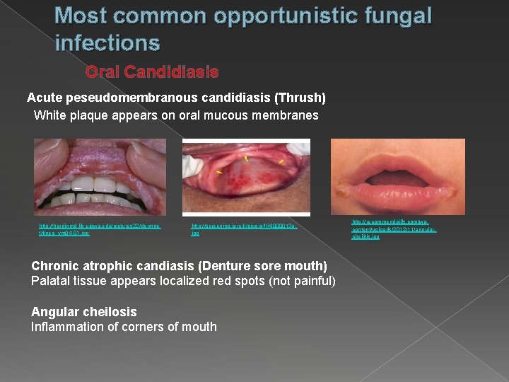 Most common opportunistic fungal infections Oral Candidiasis Acute peseudomembranous candidiasis (Thrush) White plaque appears