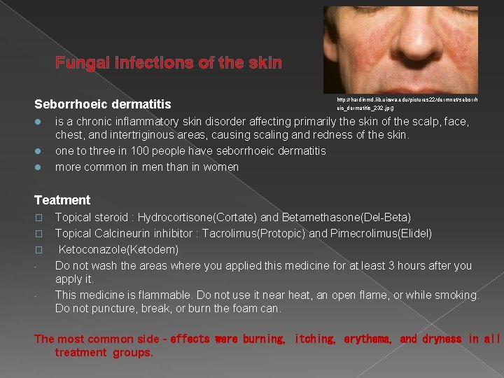  Fungal infections of the skin Seborrhoeic dermatitis l l l http: //hardinmd. lib.