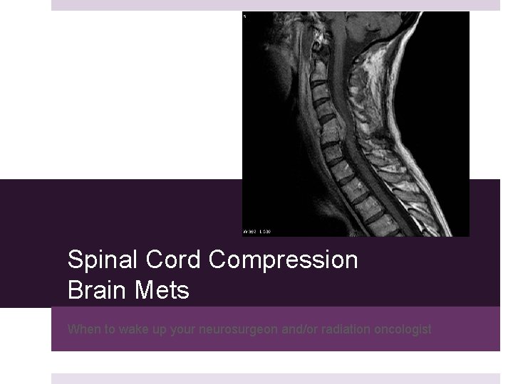 Spinal Cord Compression Brain Mets When to wake up your neurosurgeon and/or radiation oncologist